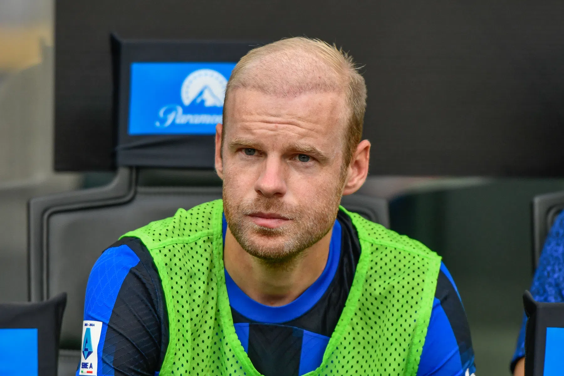 Klaassen openharig over haartransplantatie